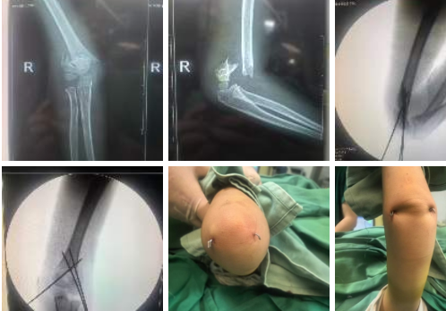 深夜急诊：为了孩子着想，我们选择了微创手术