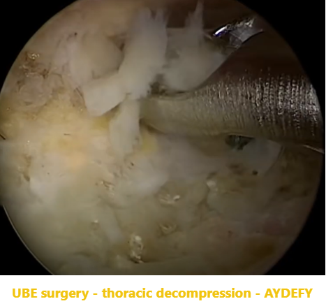 椎旁ExTLIF翻修手术中下关节突的处理